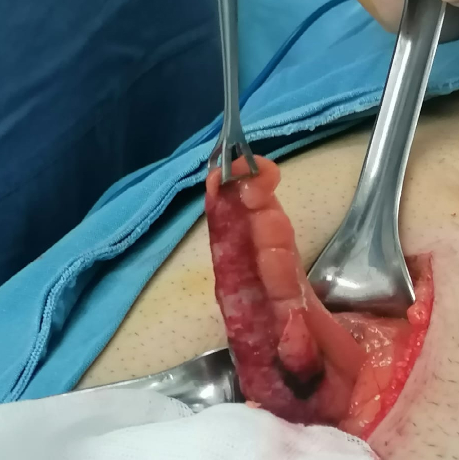 Resultado Apendicectomía 1