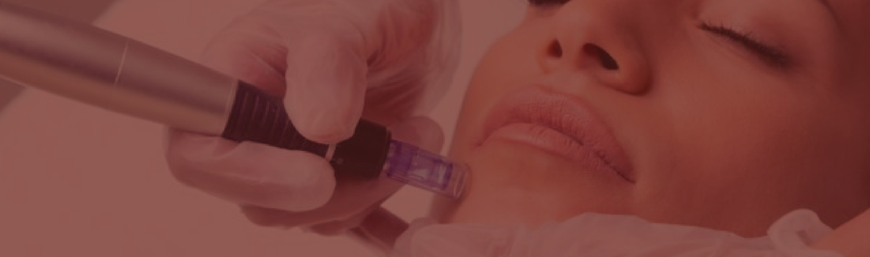 Exosomas con Dermapen