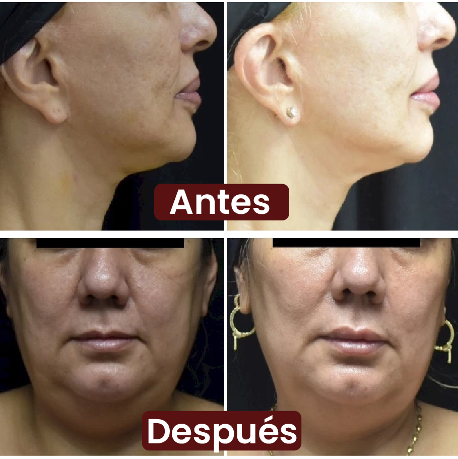 Antes y después Enzimas