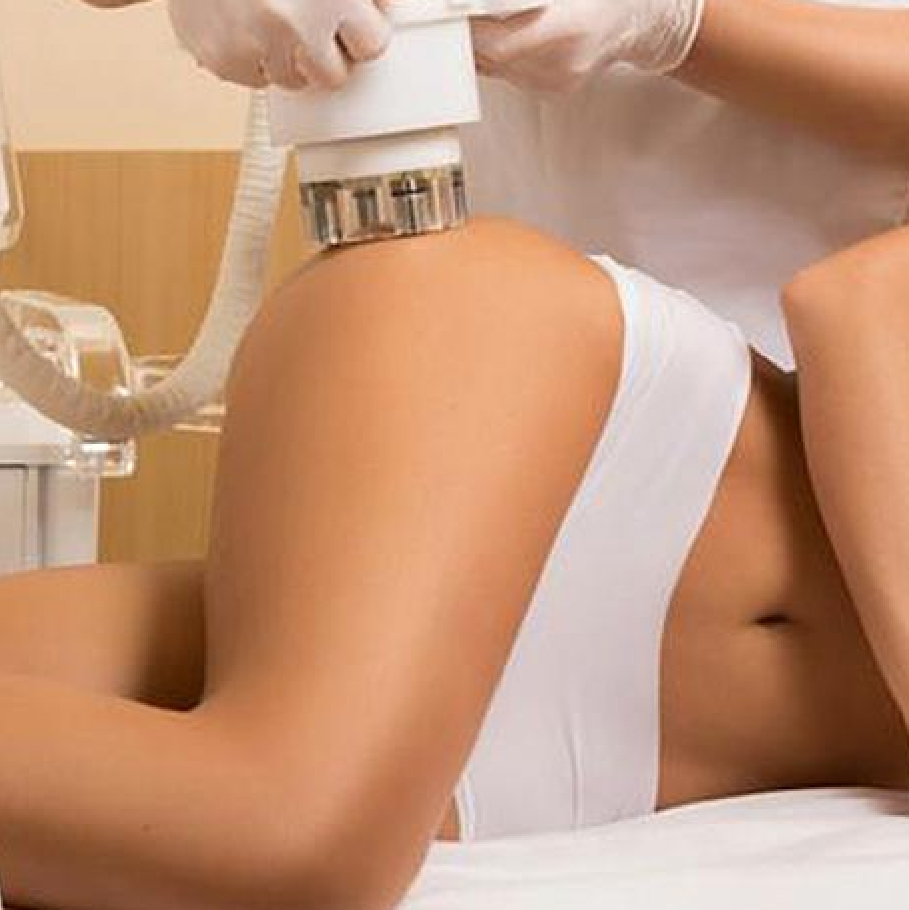 Antes y Después Glúteos 1