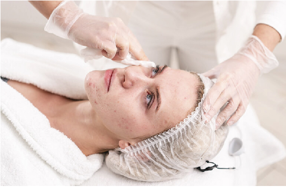 Tratamiento para Acné