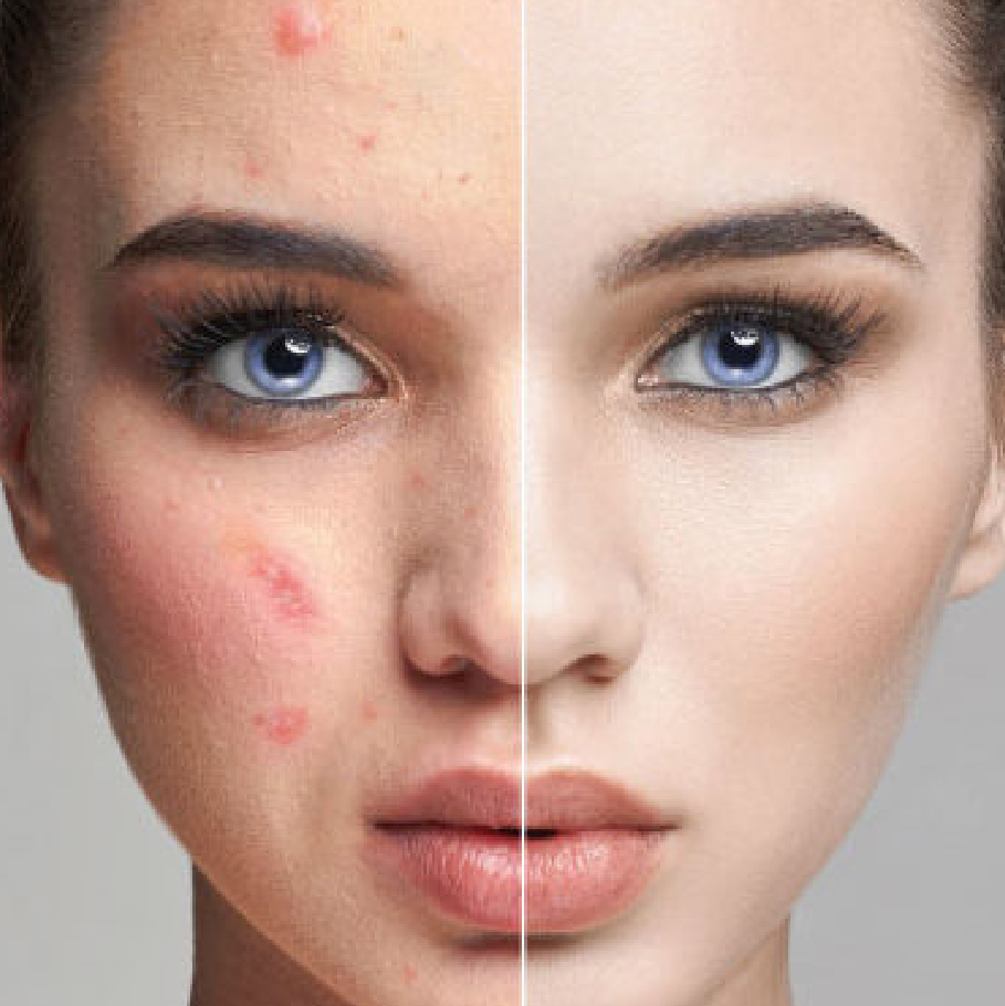 Resultado Acné 2