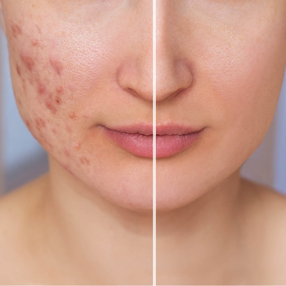 Resultado Acné 1