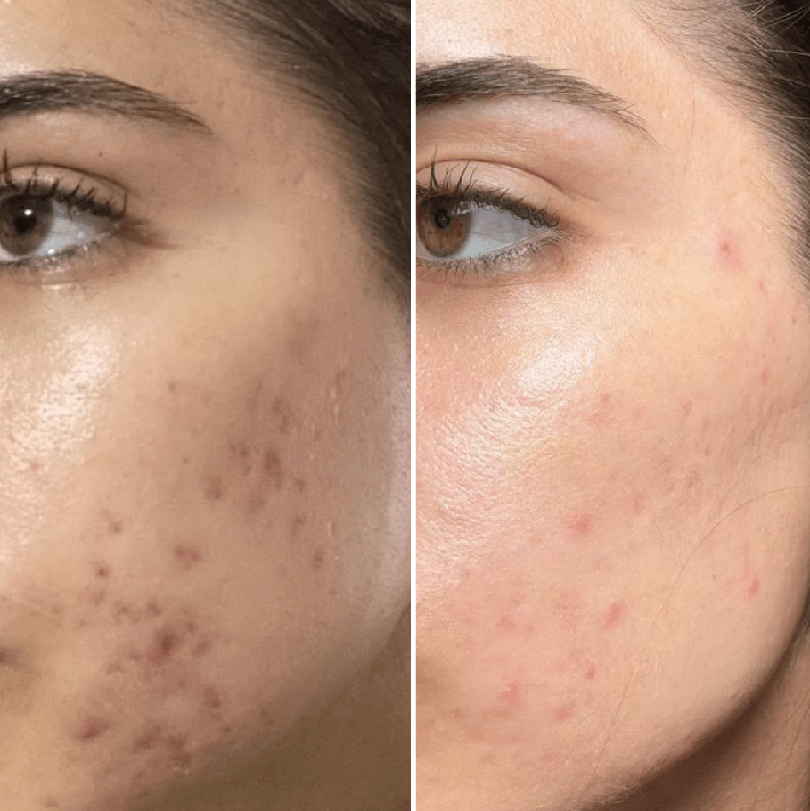 Resultado Acné 3
