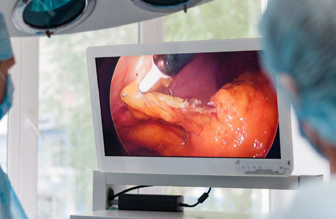 Resultado Vesícula 2